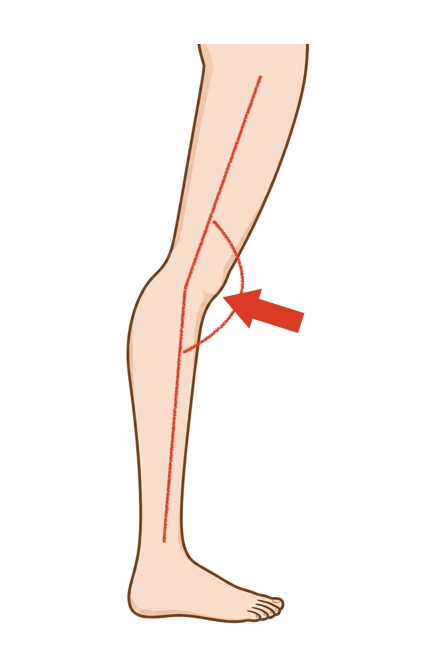 Knie nach hinten durchdruecken ueber 10 Grad
